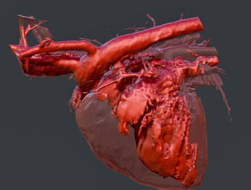 this is a 3d ct image of a heart